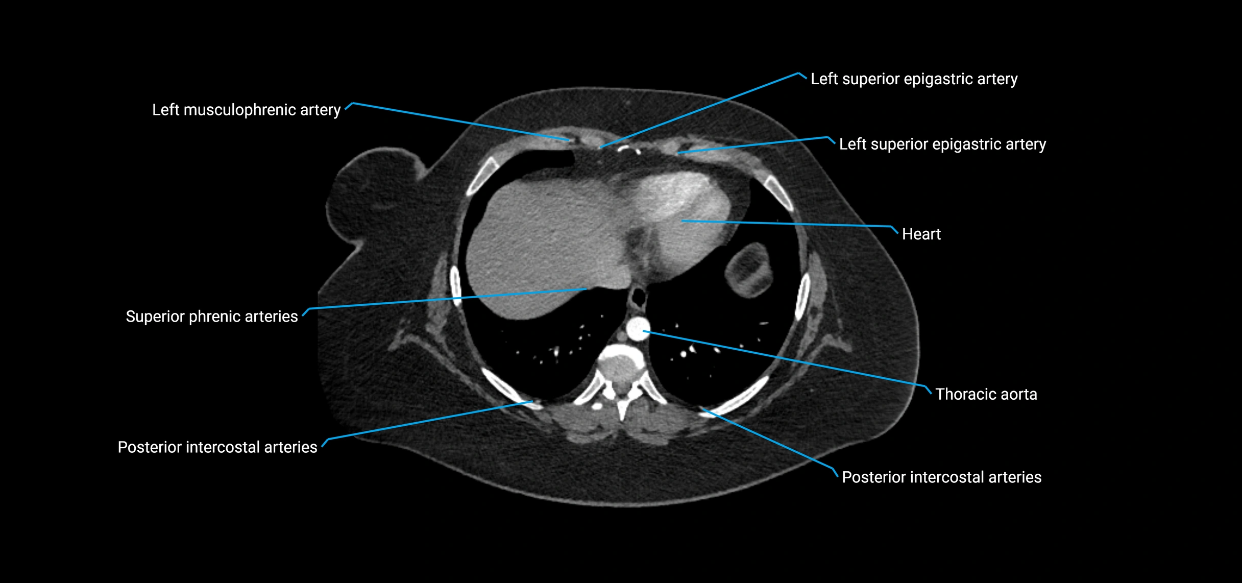 CTA abdomen axial cross sectional anatomy labelled image_13 (1).webp
